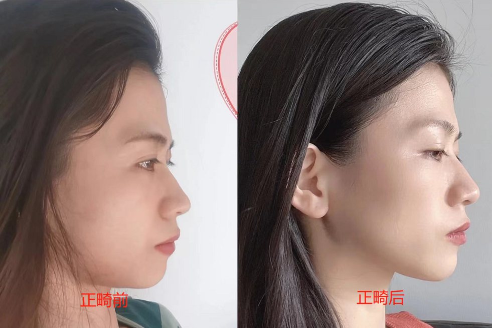 骨性嘴凸正畸效果