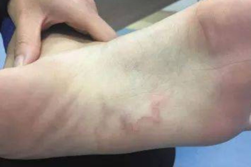 皮肤幼虫移行症