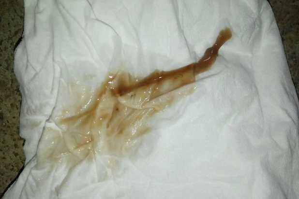 先兆流产分泌物