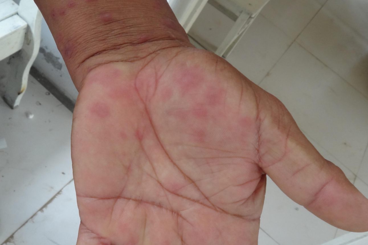 手上长过敏性紫癜