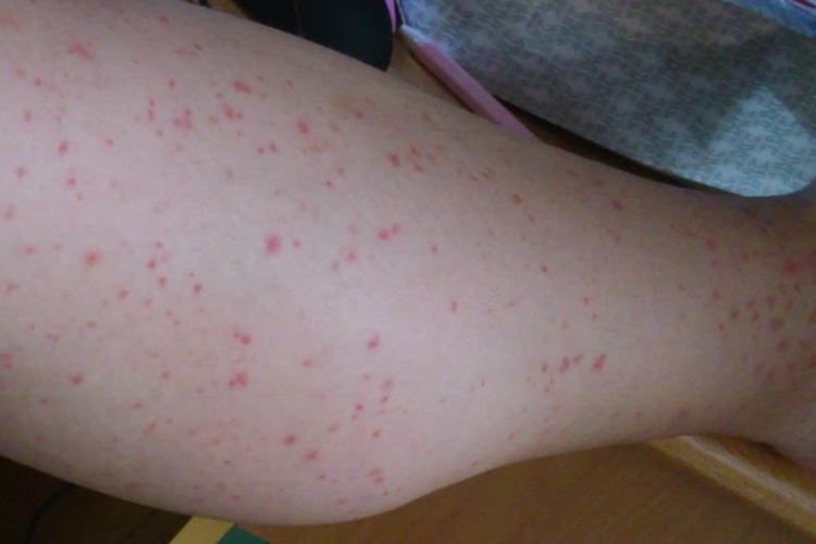 压力性紫癜出血点