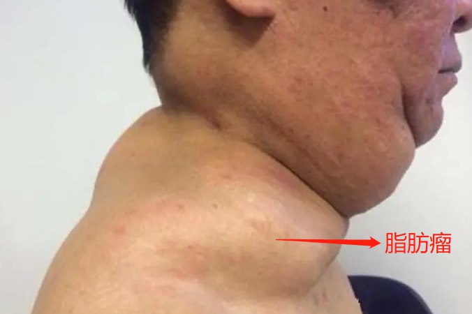 脂肪瘤
