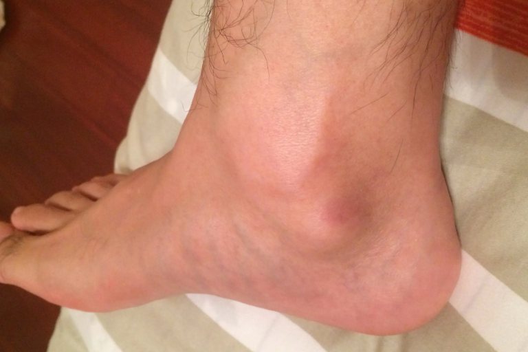 脚内侧骨头突出