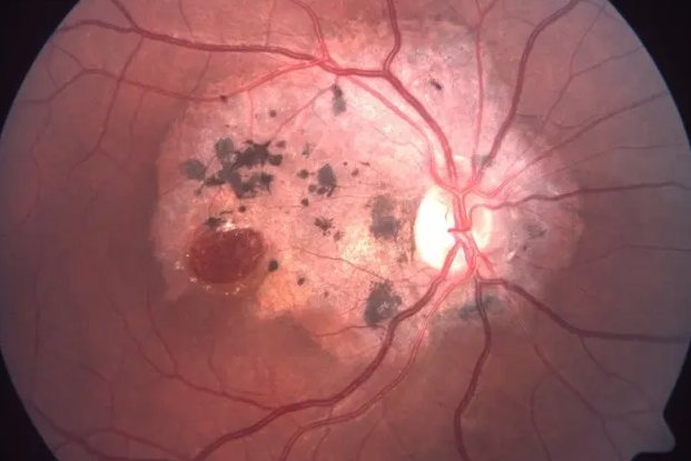 视网膜裂孔出血