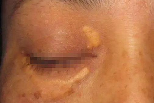睑黄疣
