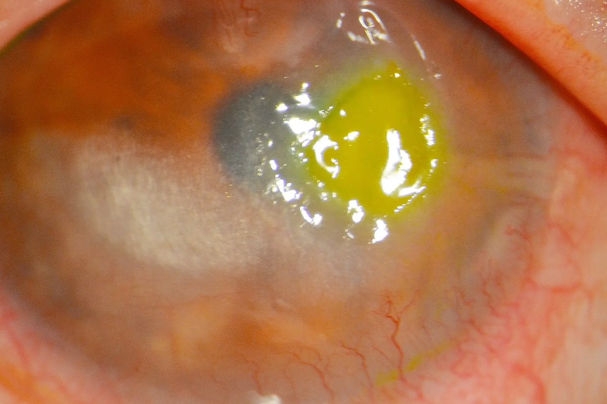 单纯疱疹病毒性角膜炎