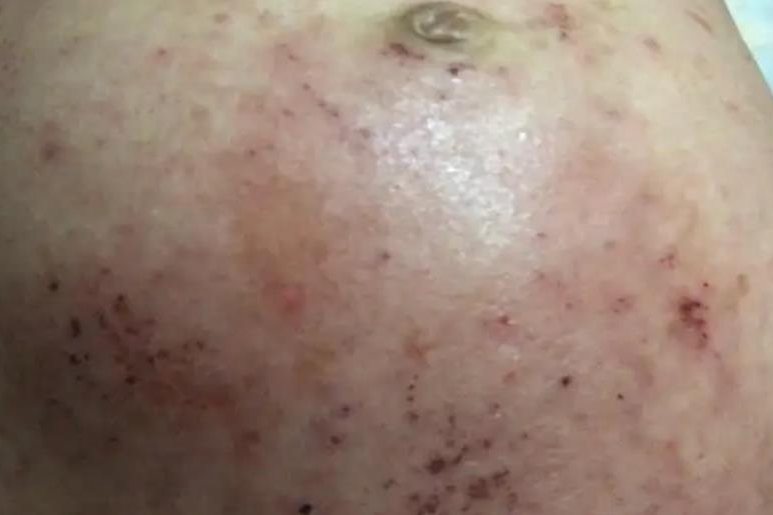 迟发型妊娠痒疹