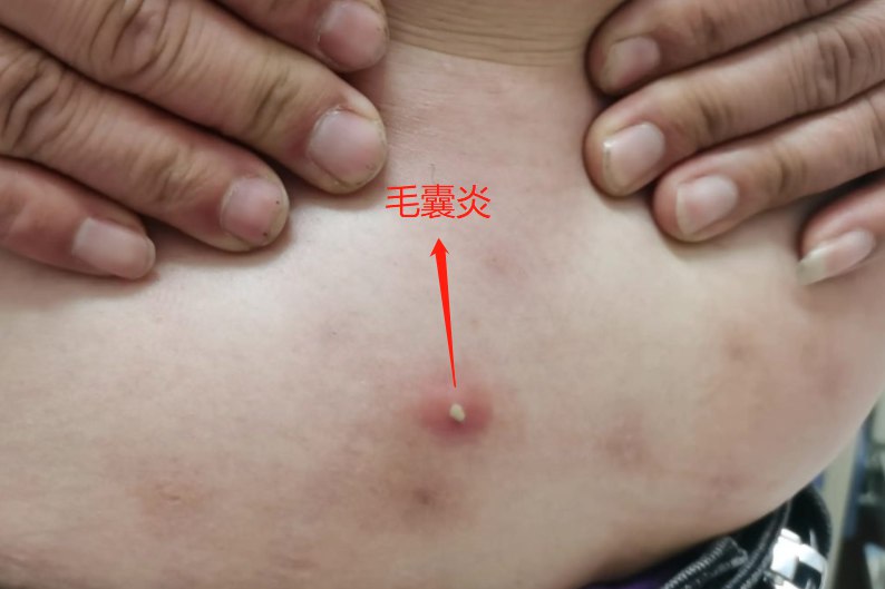 毛囊炎图片