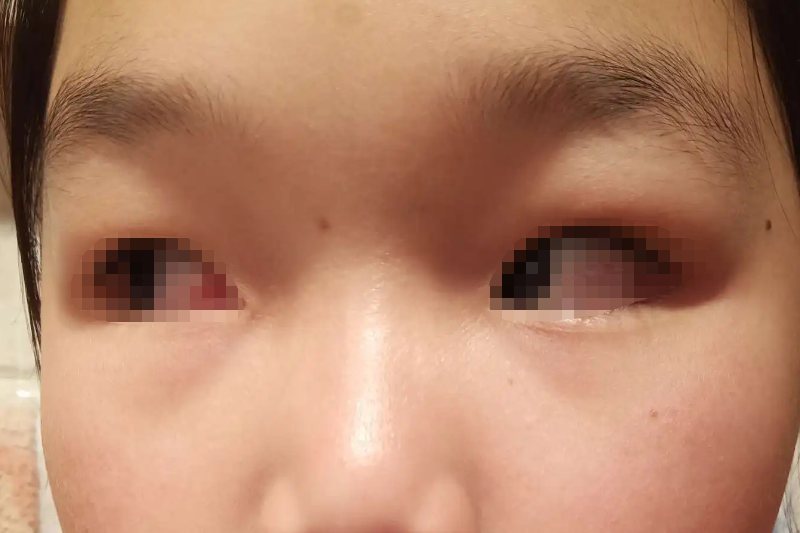 荨麻疹引起的上眼皮浮肿