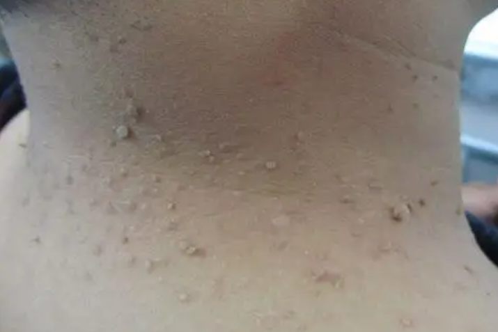 皮肤纤维瘤