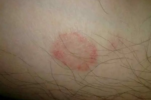 单纯性回状红斑