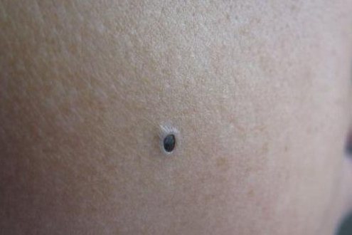 皮肤扩张孔早期