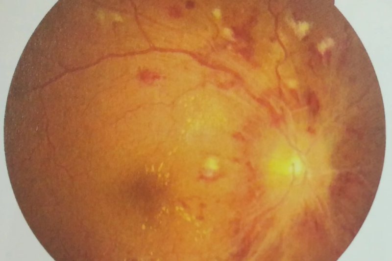 非炎症性眼底水肿