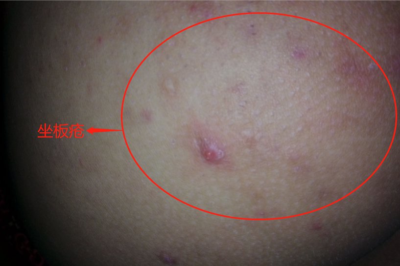 坐板疮初期图片