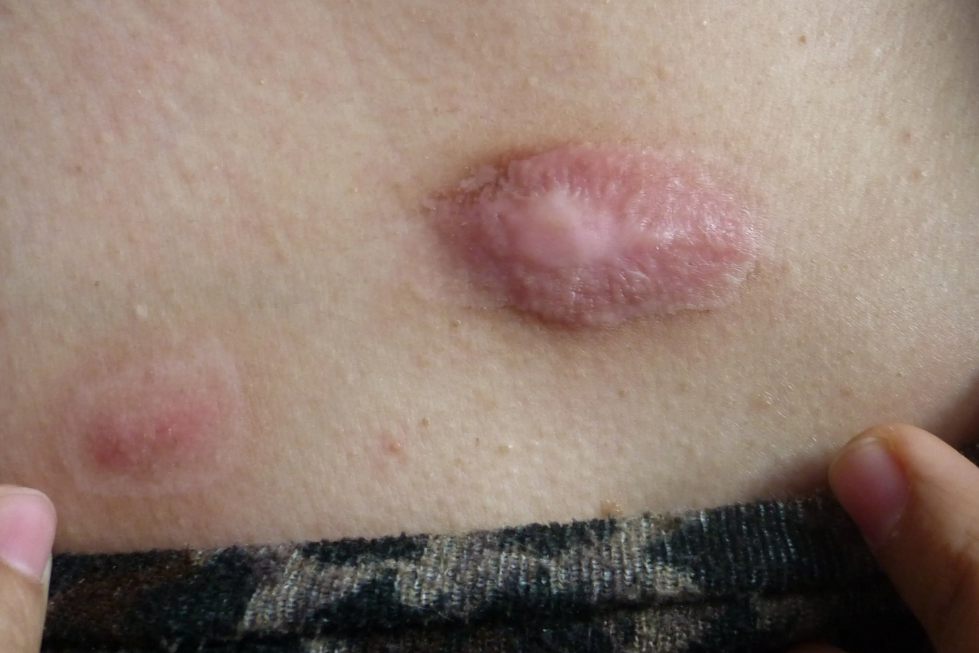 瘢痕疙瘩打封闭针后