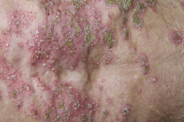 泛发性脓疱型牛皮癣