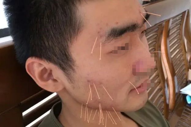 脸上扎针放血祛斑