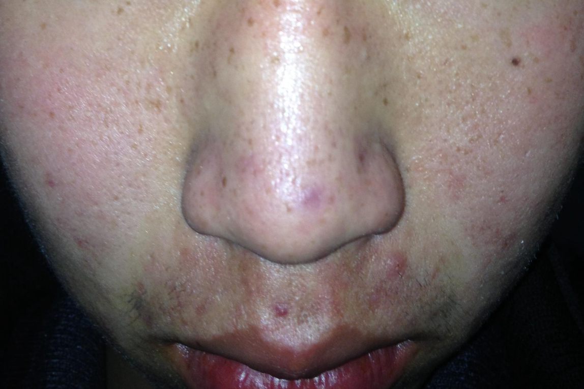 细菌性鼻毛囊炎