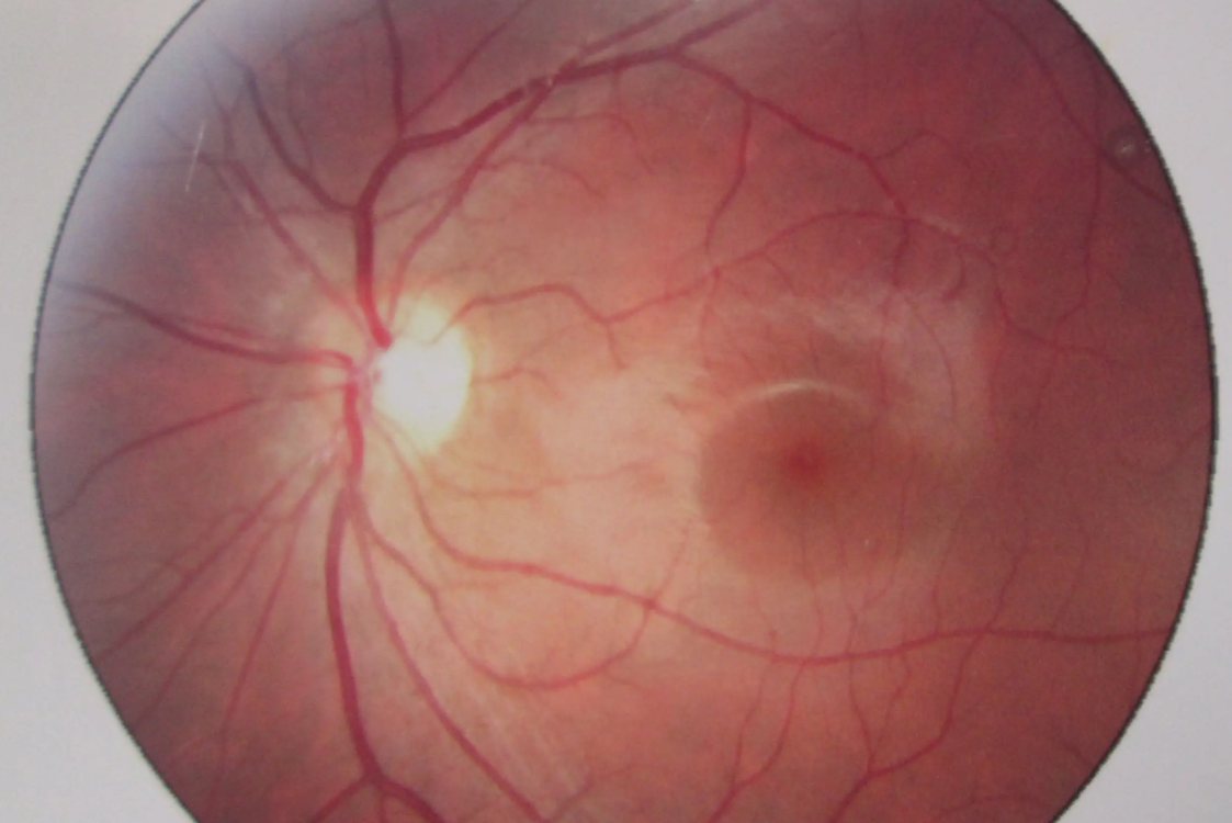 炎症性眼底水肿