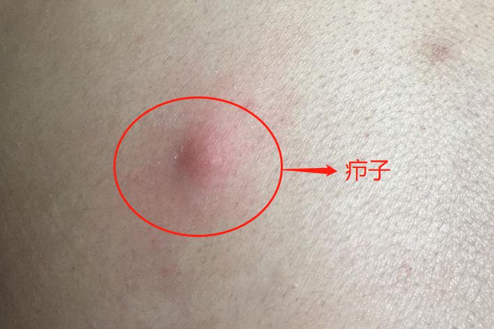 疖子图片
