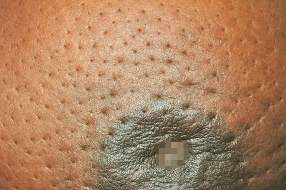 胸部橘皮状皮肤