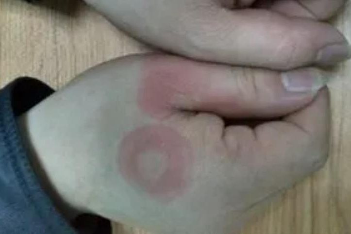 离心性环状红斑