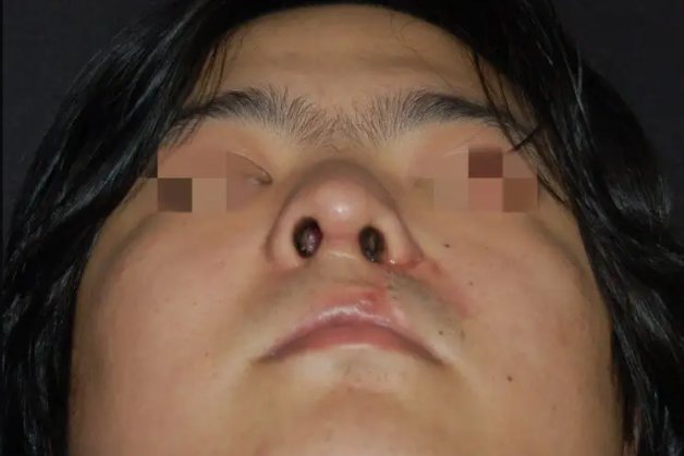 唇裂鼻子塌修复后图片