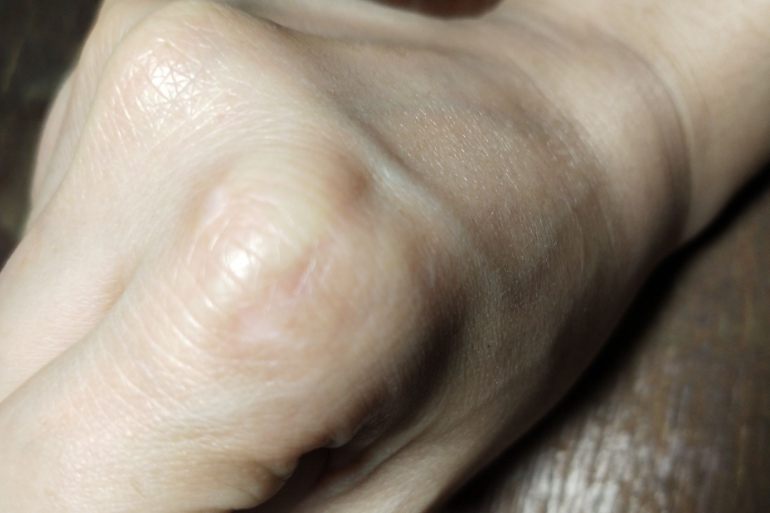 鸦胆子治疣效果图