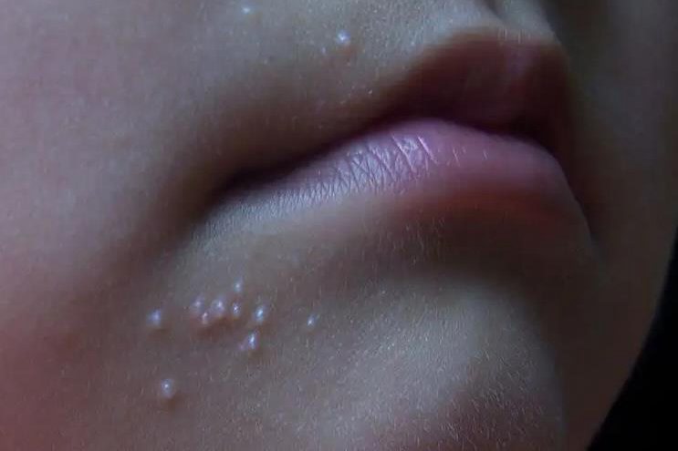 唇疱疹
