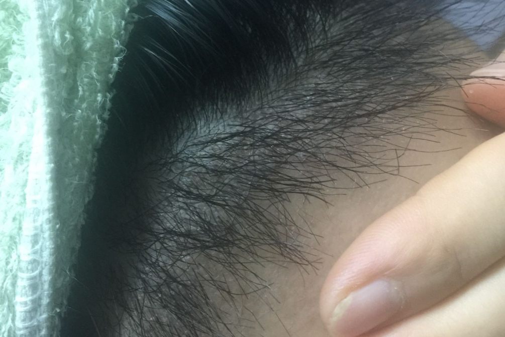 植发三个月正常的效果图