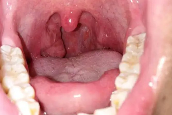 扁桃体蜂窝织炎