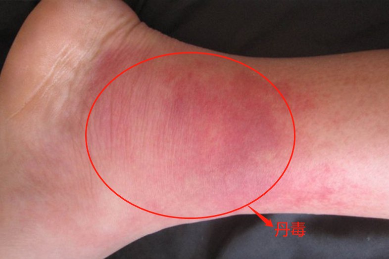 丹毒图片