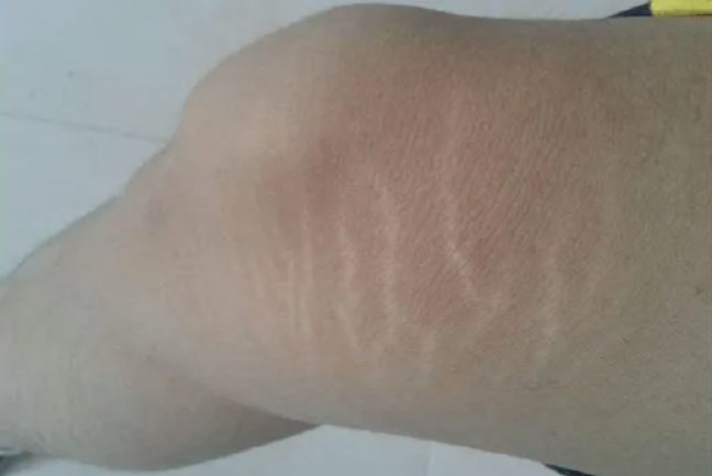 膝盖生长纹图片