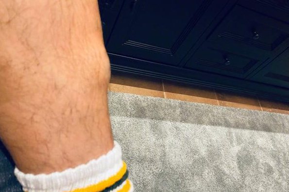 小腿被撞肿图片真实图片