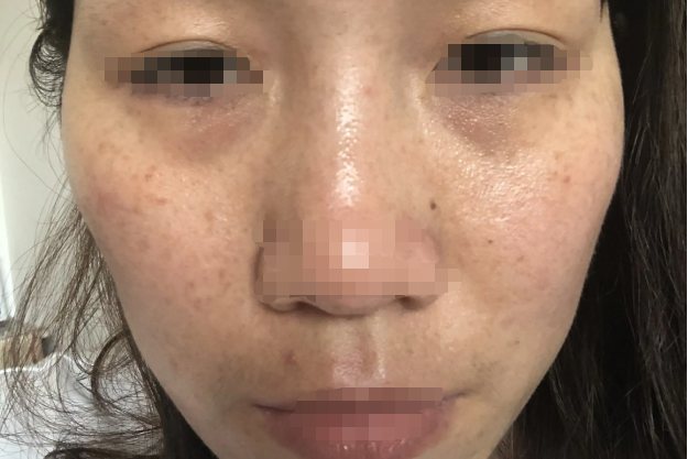 药水点斑反黑图片