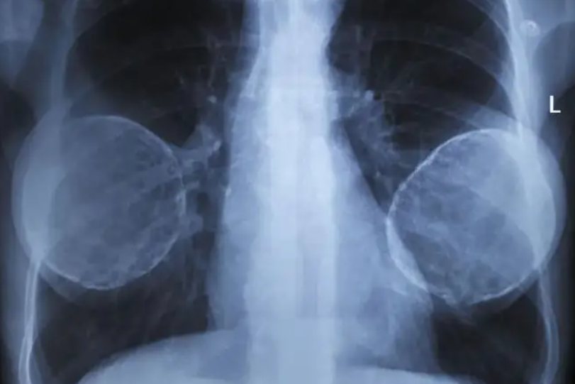 有隆胸假体的胸透图片