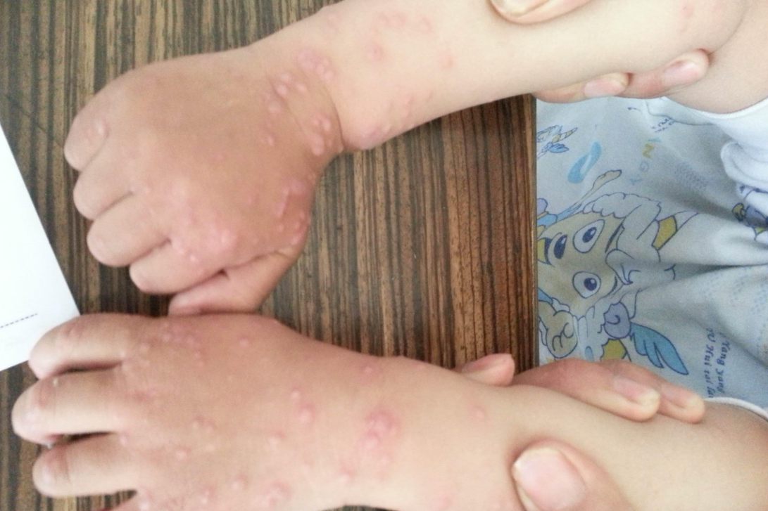 丘疹性肢端皮炎