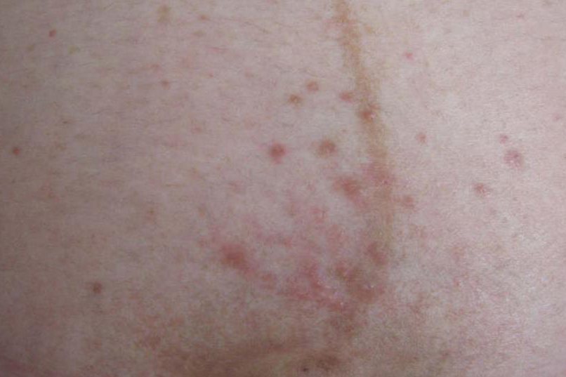 早发型妊娠痒疹