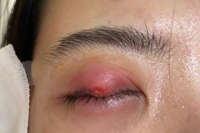 外麦粒肿开刀图片