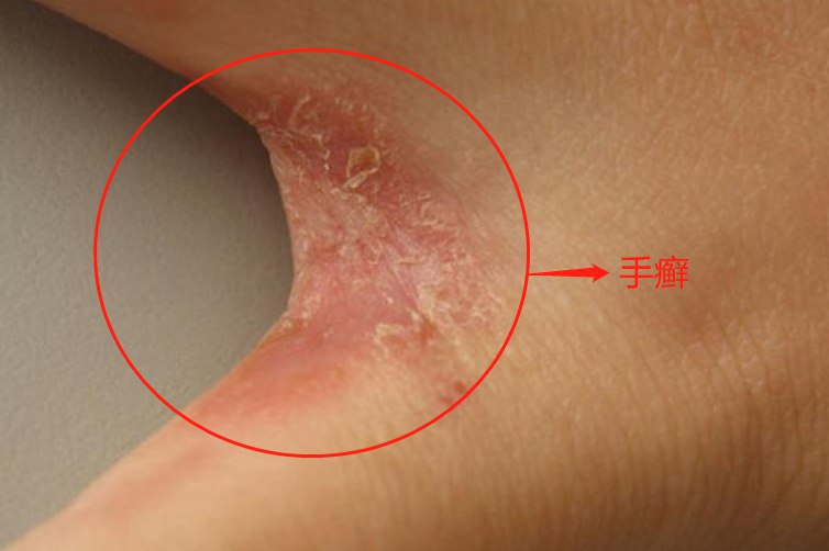 手癣