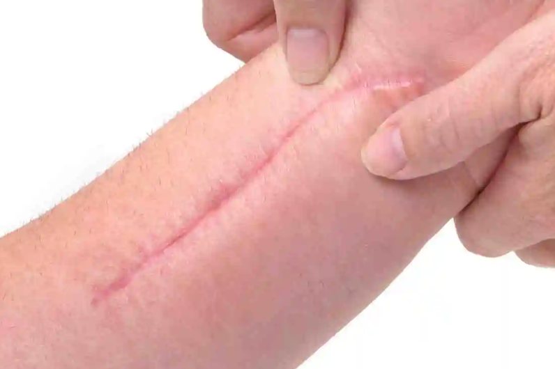 皮肤错位性凹陷疤痕