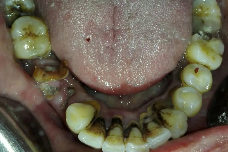 牙被虫吃了一半