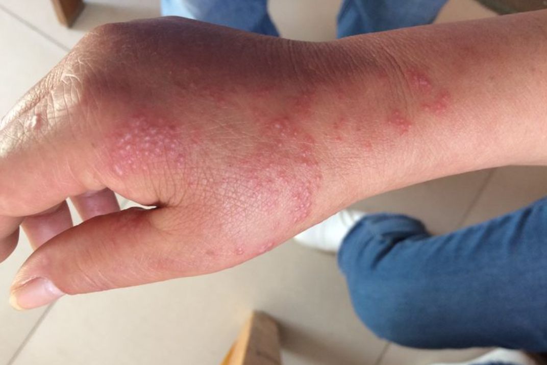 带状疱疹初期症状