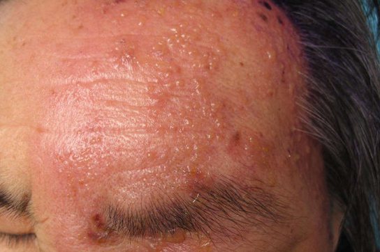 老年疱疹早期症状