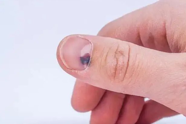 指甲里面有黑色的斑点