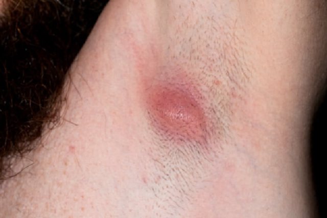 恶性腋下淋巴结