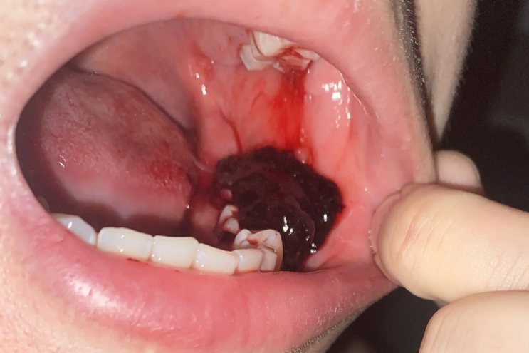 拔牙后第二天伤口正常图片