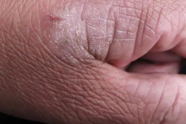 虎口湿疹