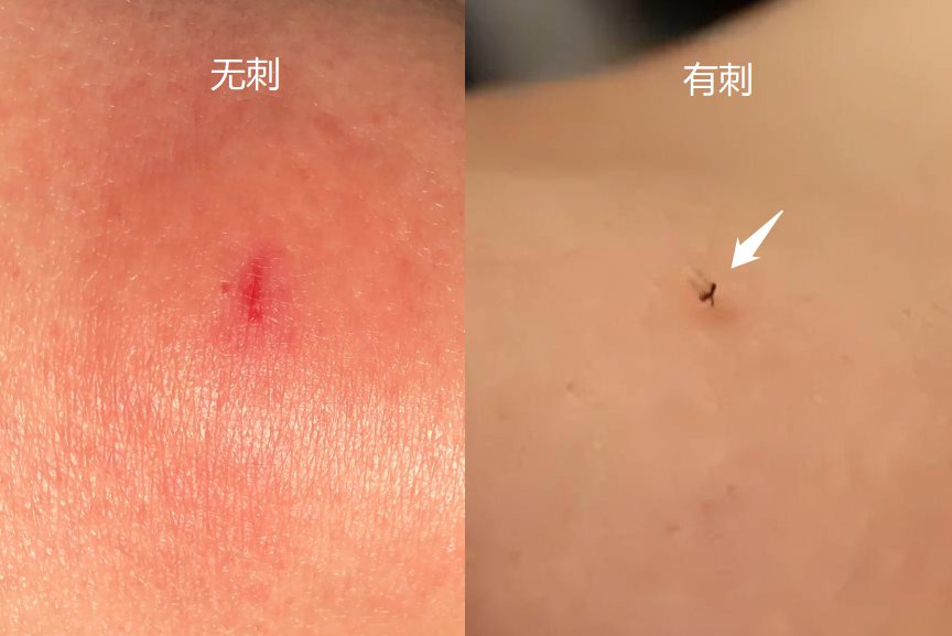 马蜂蜇了判断是否有刺