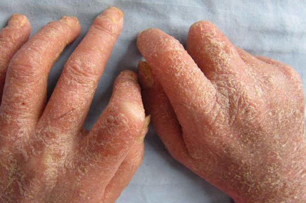 关节病型银屑病